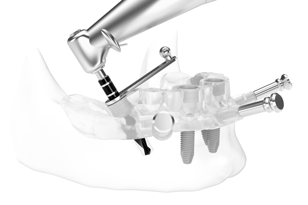 NobelGuide Guided Surgery used at PERFECT SMILE Dental Clinic